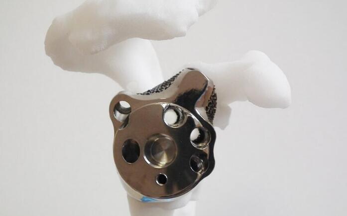 医生用3D打印定制化植入物治疗肩胛骨关节盂相关疾病