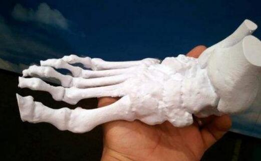 3D打印技术在骨肿瘤外科的现状与展望