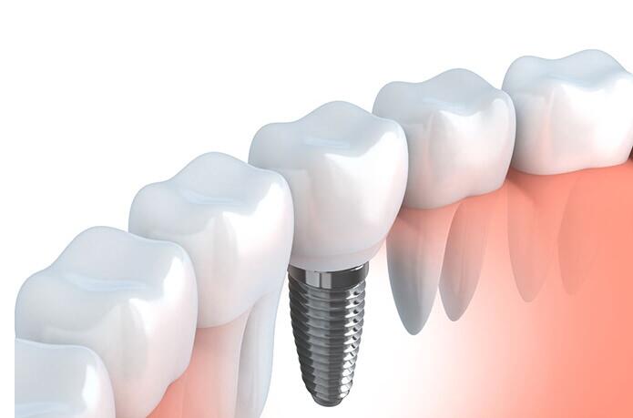 预计8千一颗“3D打印牙” 你会做吗？