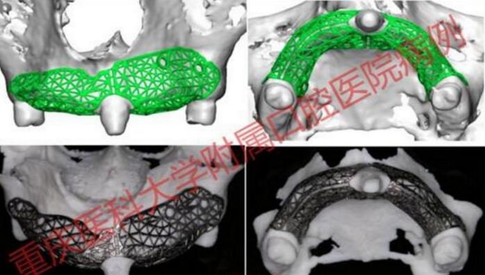 全国首例3D打印个性化钛网修复大面积牙槽骨缺损
