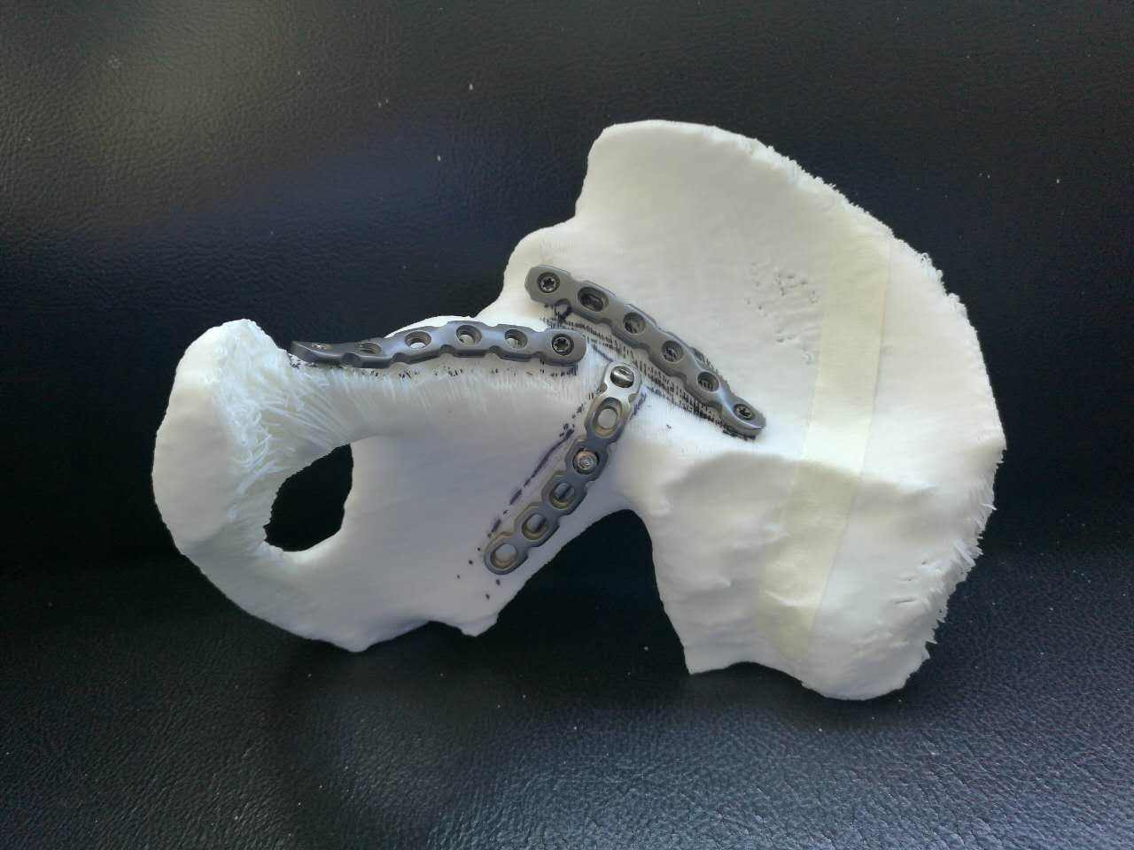 骨科3D打印